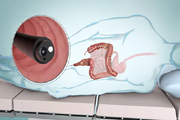 Sigmoidoscopy