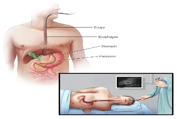 Endoscopic Ultrasound